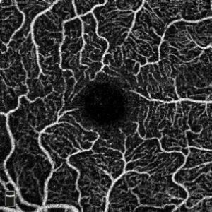 OCT-Angiography provides a high-resolution image of blood vessels in this diabetic subject's eye